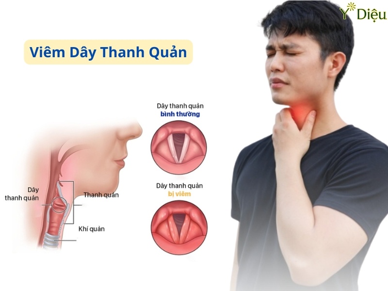 Viêm Thanh Quản: Triệu Chứng, Nguyên Nhân và Cách Điều Trị